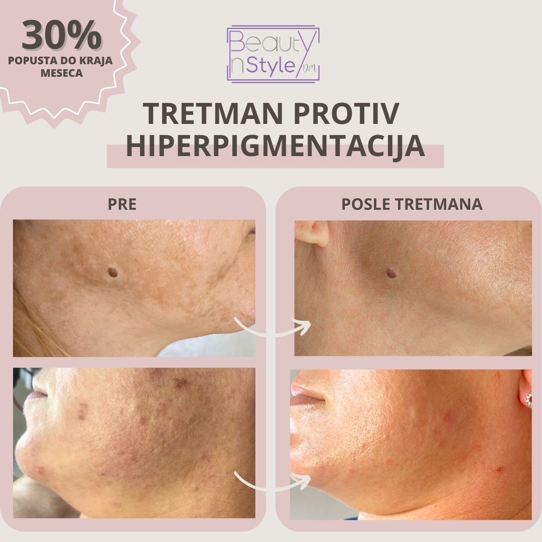 Beauty in Style DM #novisad Tretman lica Hemijski piling za hiperpigmentacije