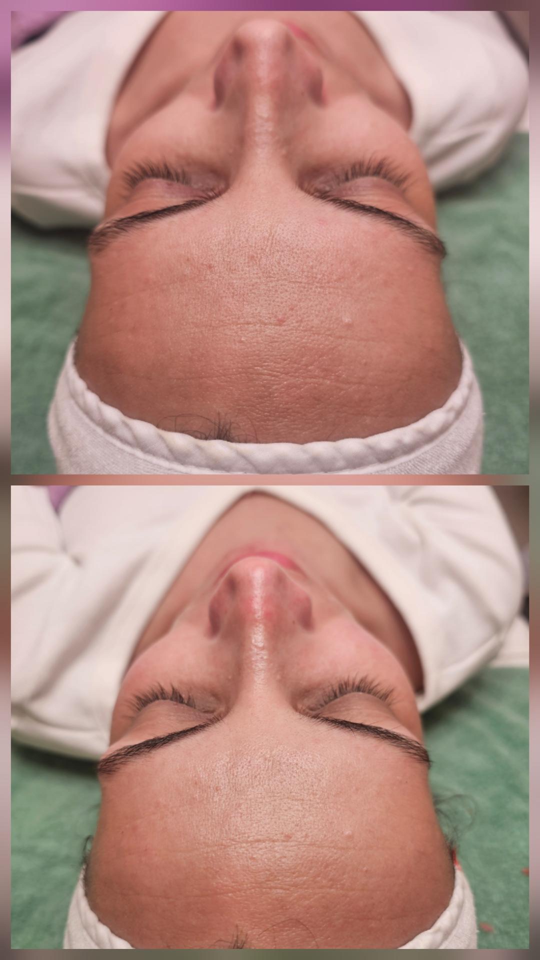 Choco Love #beograd Tretman lica Higijenski tretman lica + hemijski piling