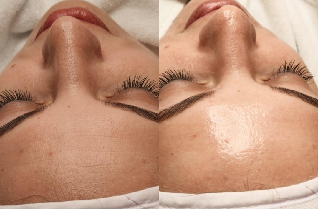 Choco Love #beograd Tretman lica PRX therapy