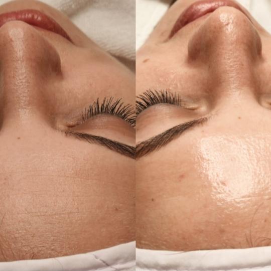 Choco Love #beograd Tretman lica PRX therapy Tretman PRX 
Pruža dubinsku regeneraciju, podmlađiva