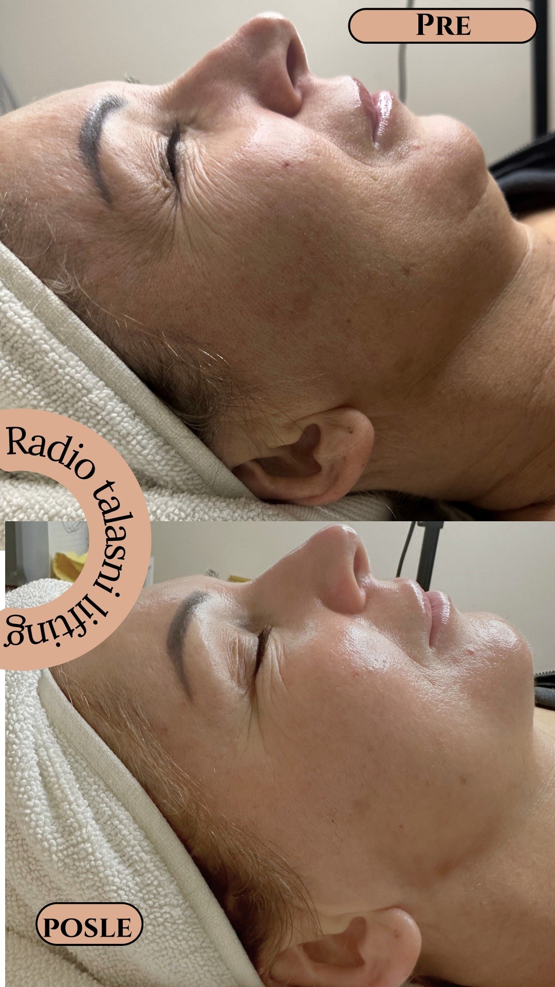 Radiotalasni lifting - lice + vrat - Zen Club, Beograd Tretman lica Lice Tretman lica, Beograd, Vidikovac, Petlovo brdo, Labudovo brdo