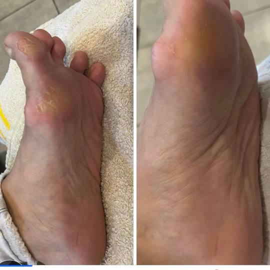 Super stil Marija #zrenjanin Izlivanje noktiju Medicinski pedikir