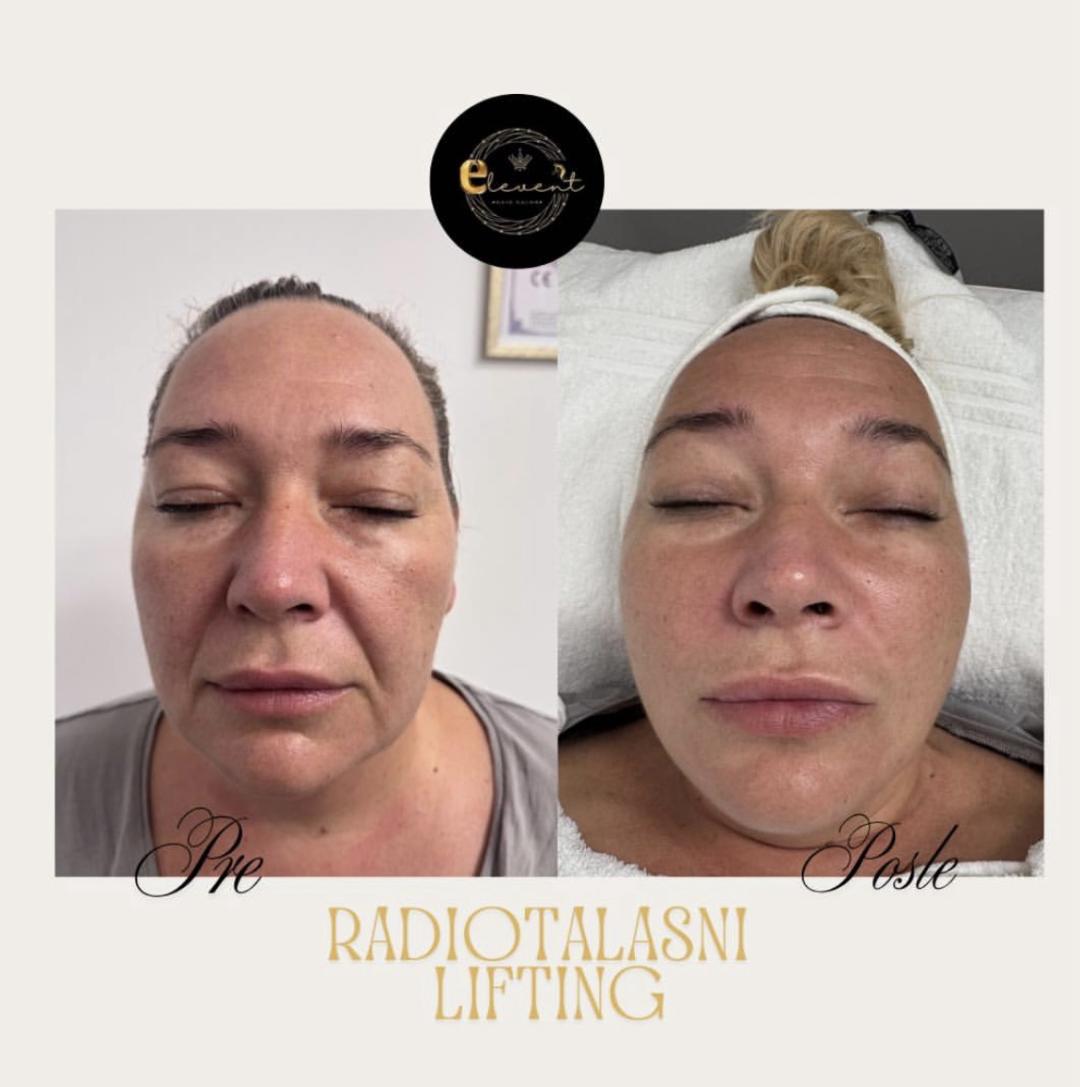 Elevent #beograd Radiotalasni i ultrazvučni tretmani Raditalasni lifting - lice
