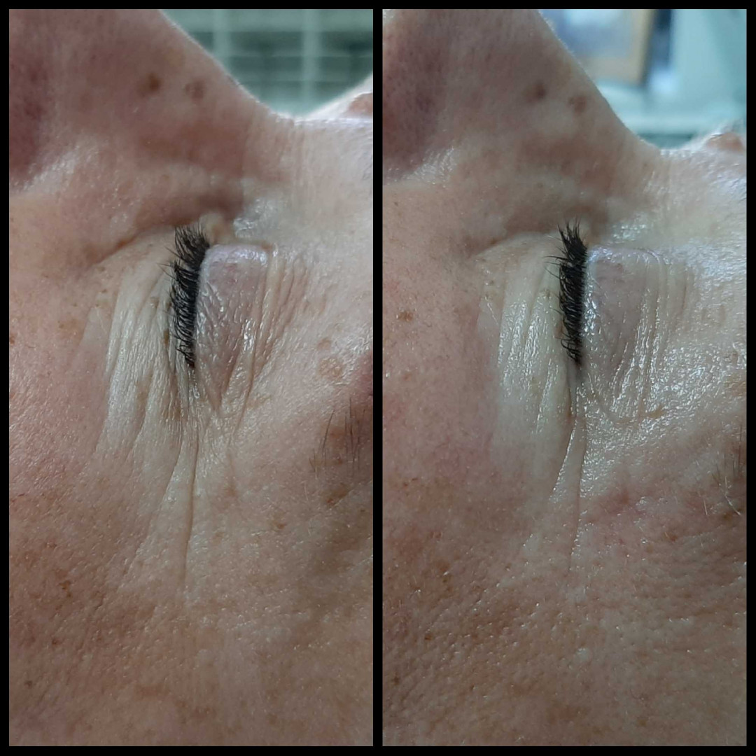 Look at me #beograd Tretmani protiv bora 3D Wrinkle tretman lica