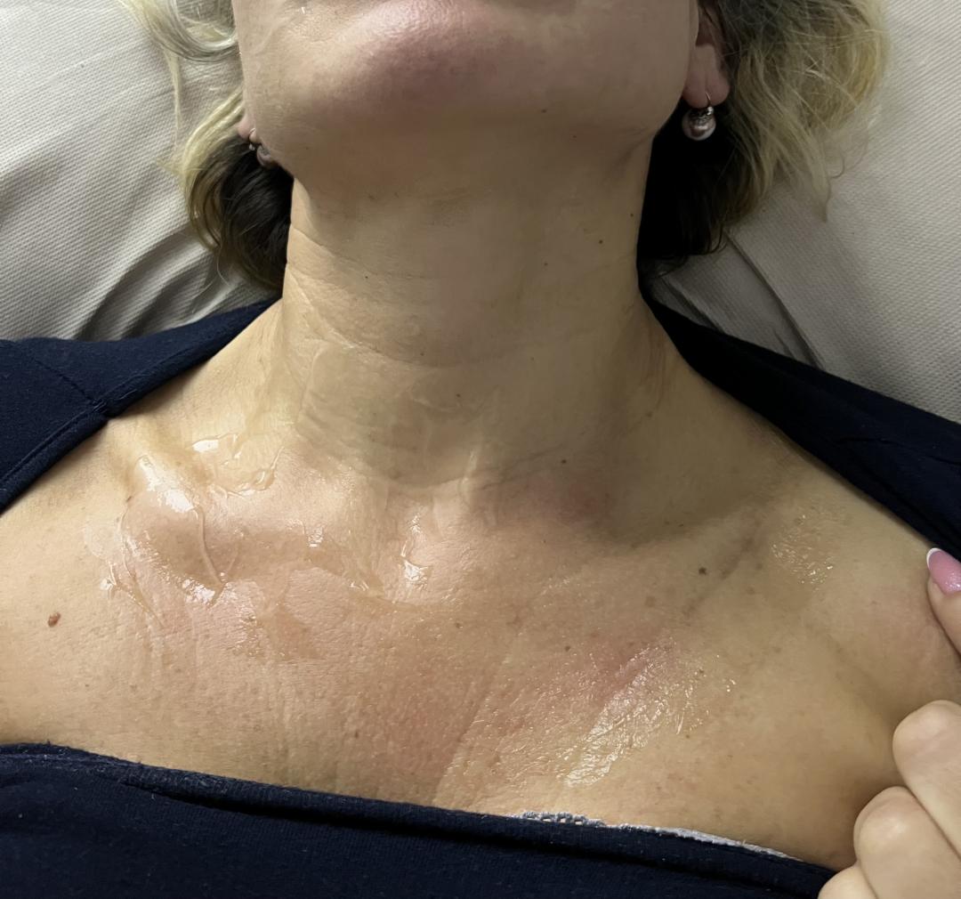 Amelini beauty concept #beograd Radiotalasni i ultrazvučni tretmani Radiotalasni lifting lica - paket od 6 tretmana