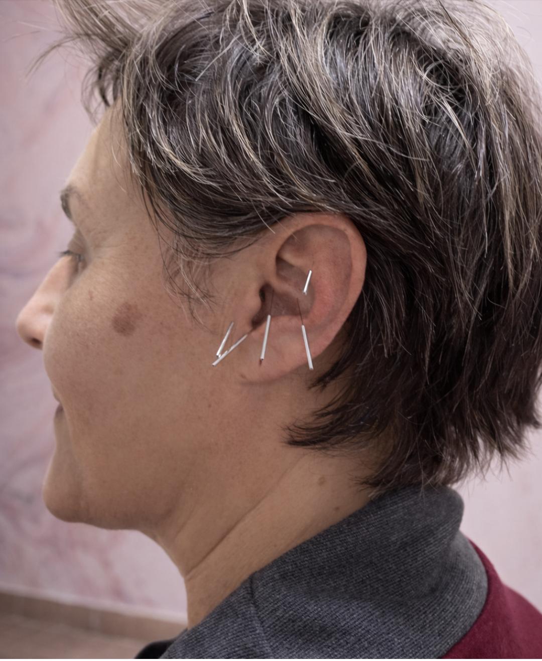 Akupunktura za mršavljenje - Edumaris, Pančevo Nutricionista Wellness Nutricionista, Pančevo, Centar