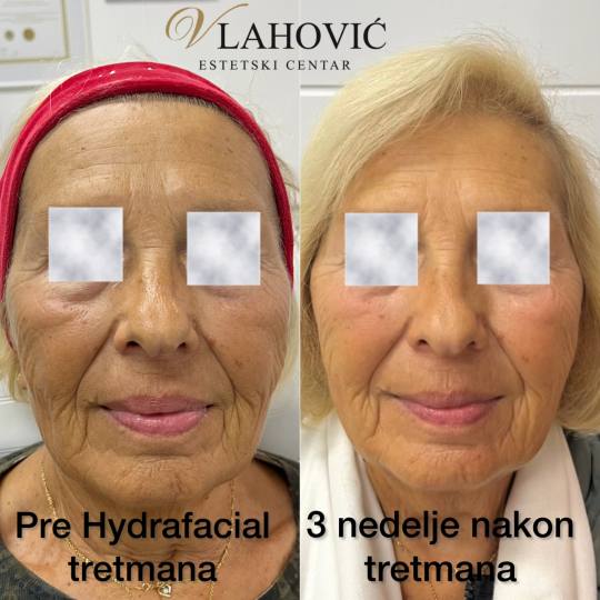 Estetski centar Vlahović #beograd Tretman lica HYDRAFACIAL - regeneracija i rejuvenacija kože Pono