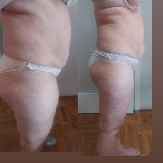 Anita M #novisad Kavitacija Ultrazvučna kavitacija + bipolar rf stomaka + gluteusa + nogu - paket o