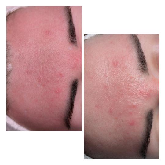 Brow & Glow #novisad Tretman lica Anti redness Tretman koji ublažava crvenilo kod osetljive, kože 