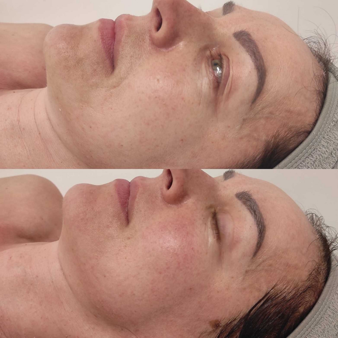 Olja Beauty #beograd Tretman lica Tretman čišćenja lica + fitopiling