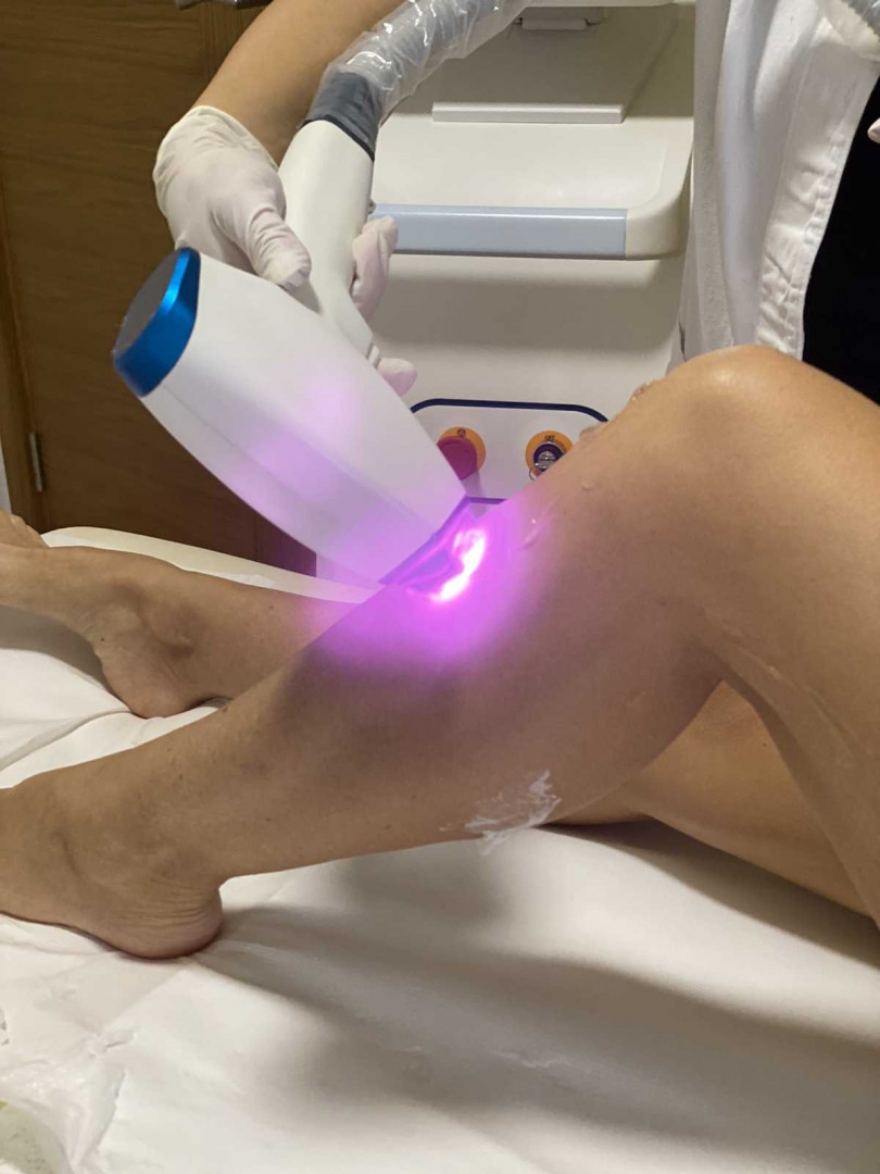 D&D Beauty Center #beograd Laserska epilacija Laserska epilacija pola nogu - za dame