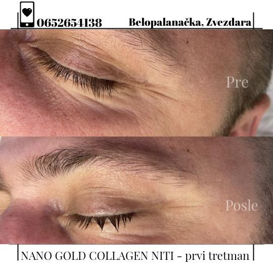 Oui Oui #beograd Tretman lica Tretman Nano Gold Collagen niti - po regiji