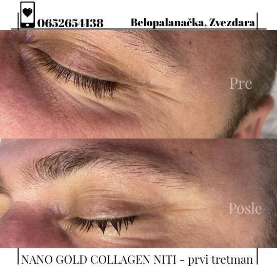 Oui Oui #beograd Tretman lica Tretman Nano Gold Collagen niti - po regiji