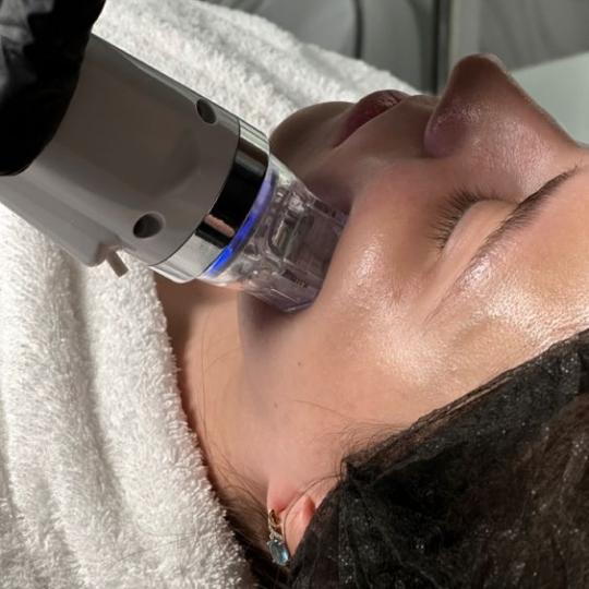 AmiSo Beauty Studio #novisad Lifting / zatezanje kože Aparatni RF lifting lica Velashape (60 min)