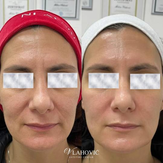 Estetski centar Vlahović #beograd Tretman lica HYDRAFACIAL - regeneracija i rejuvenacija kože HYDR