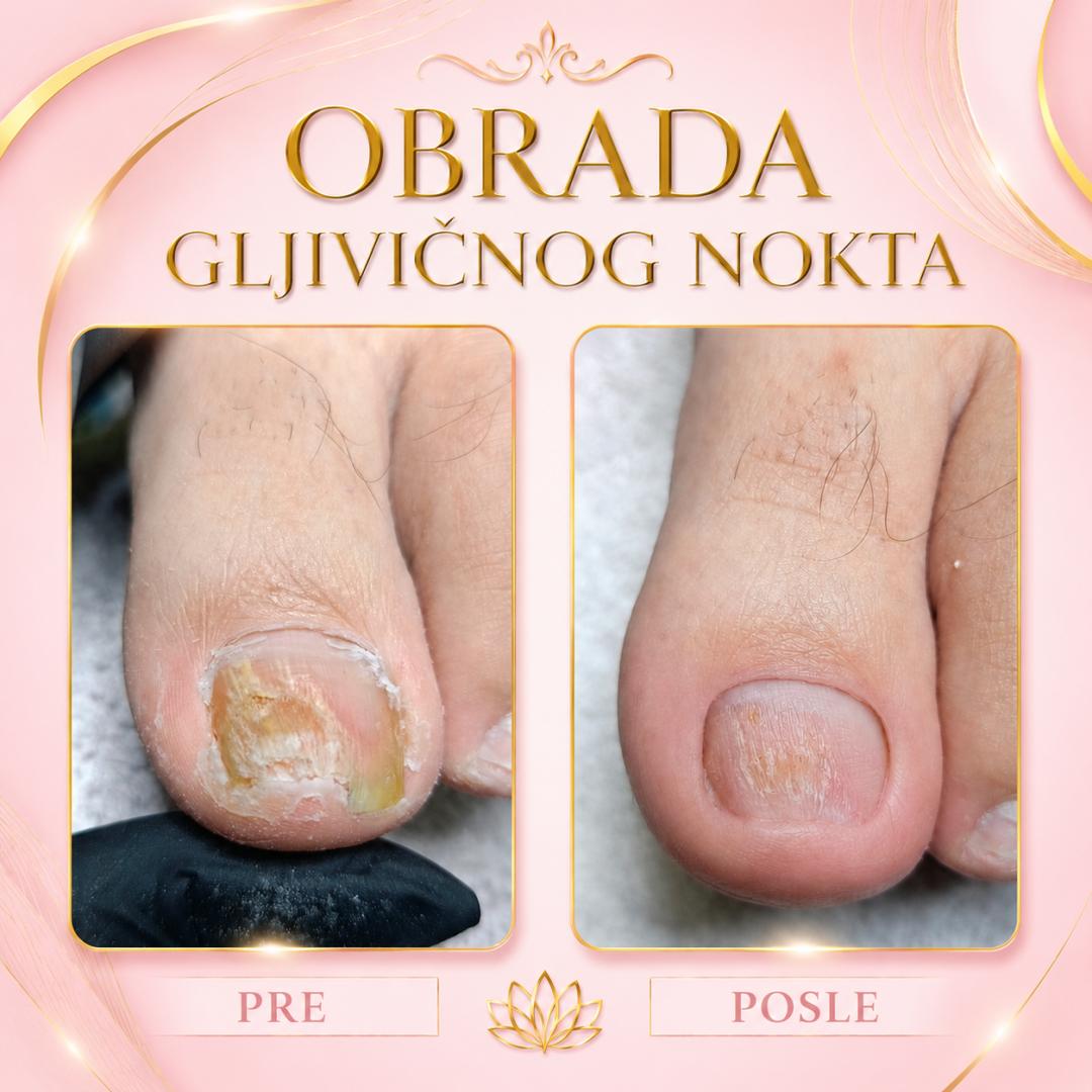Obrada gljivičnog nokta velikog (cena po noktu) - Fenix, Beograd Medicinski pedikir Nokti Medicinski pedikir, Beograd, Dušanovac, Šumice