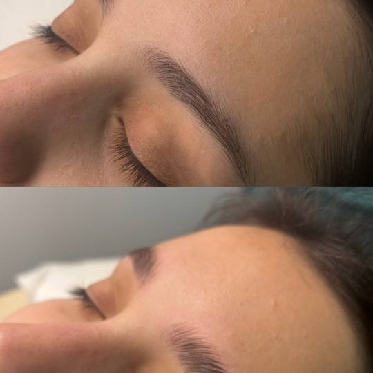 SZFR Igor #beograd Obrve Brow lift