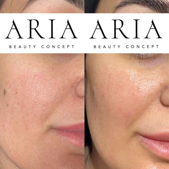 Aria Beauty Concept #pancevo Tretman lica Microneedling-biorevitalizacija Pre i nakon serije tretman