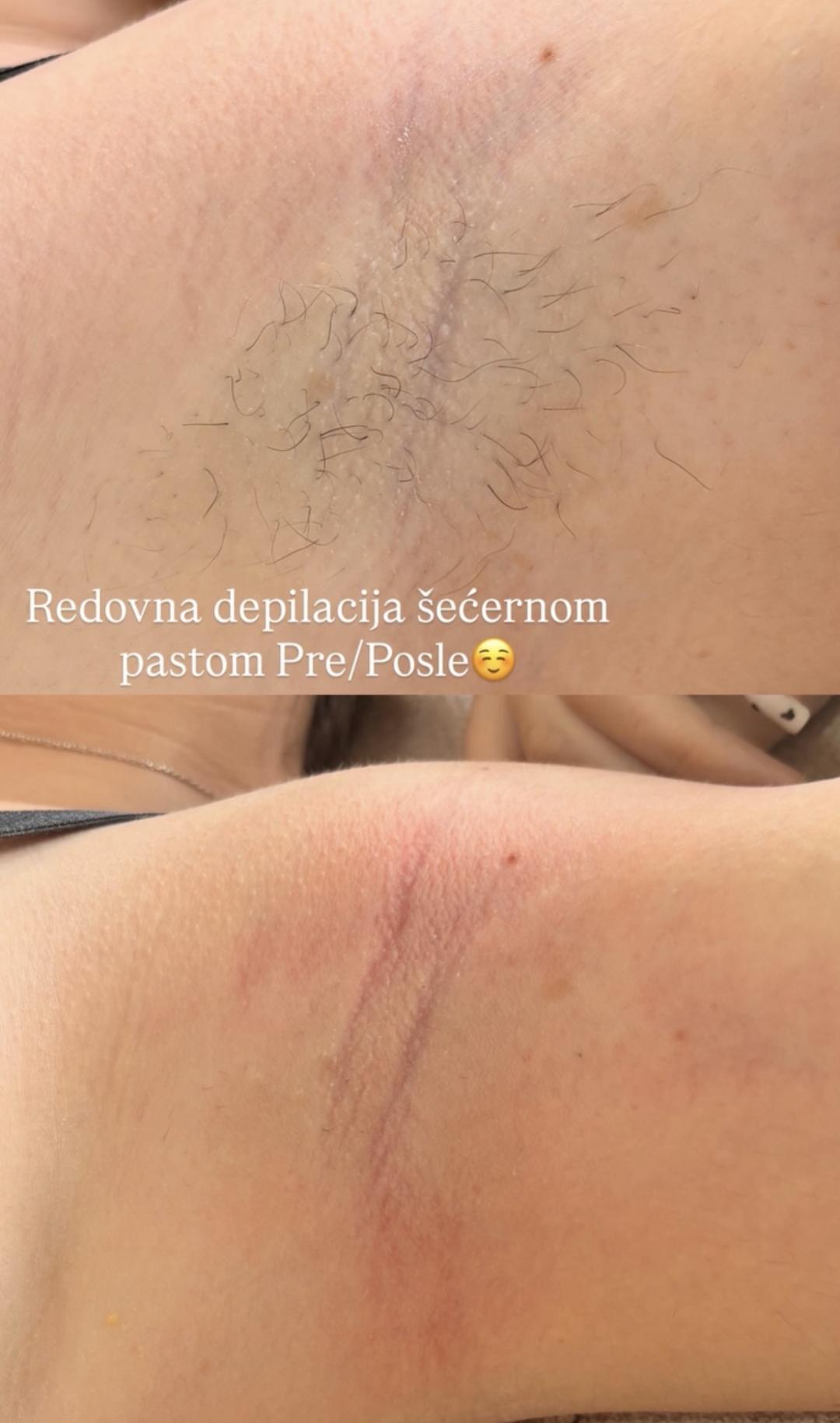 Almari Beauty Concept #kragujevac Depilacija šećernom pastom Depilacija pazuha šećernom pastom - za dame