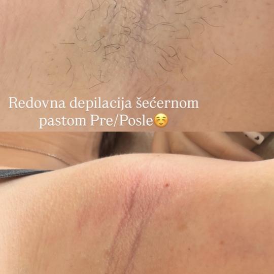 Almari Beauty Concept #kragujevac Depilacija šećernom pastom Depilacija pazuha šećernom pastom -