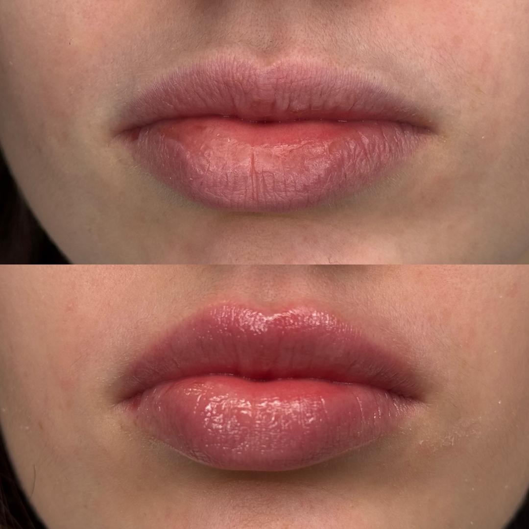 Hydralips-mezoterapija usana hijaluronom - L’Avenue, Beograd Mezoterapija lica Lice Mezoterapija lica, Beograd, Centar, Stari grad, Dorćol