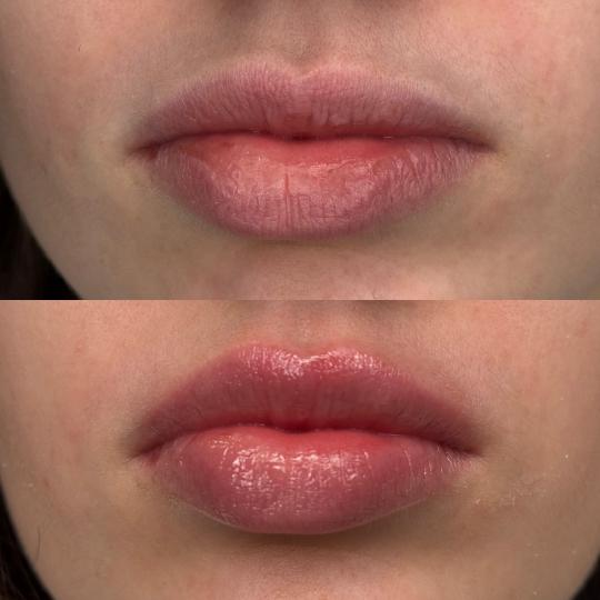 L’Avenue #beograd Mezoterapija lica Hydralips-mezoterapija usana hijaluronom