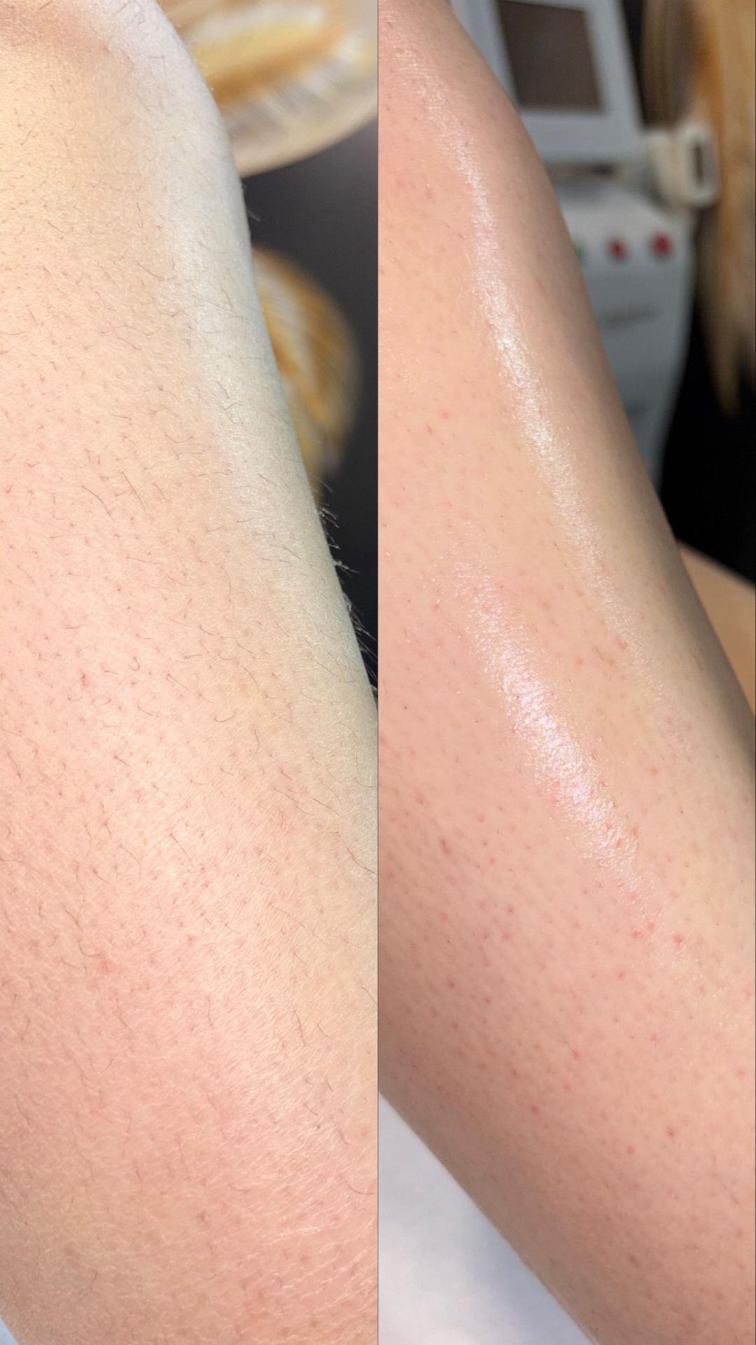 Angels #novisad Depilacija nogu Depilacija celih nogu + prepona toplim voskom - za dame