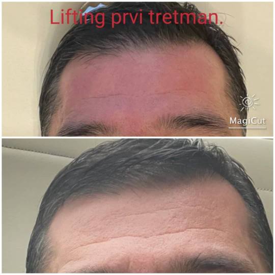 Lipolaser Centar - Matrix021 #novisad Tretman lica Zatezanje lica bez bola, na prirodan način obnav