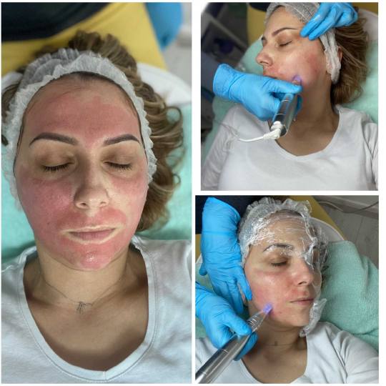 2 Cats 1 #beograd Dermaroler i dermapen Dermapen lice + vrat Dermapen je elektronski uređaj koji im