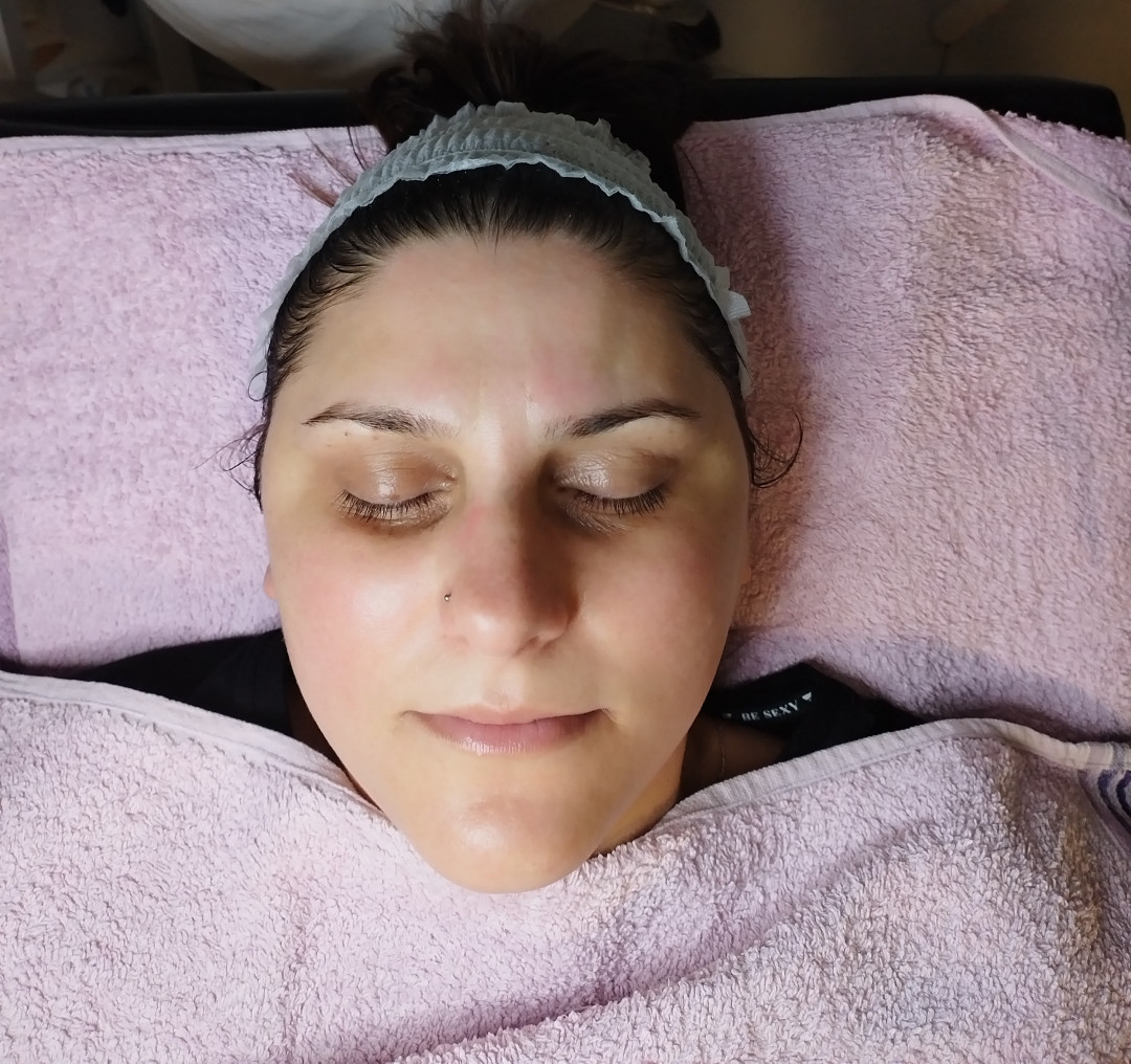 Hemijski piling za akne - Beauty in Style DM, Novi Sad Tretman lica Lice Tretman lica, Novi Sad, Sajmište, Detelinara, Banatić