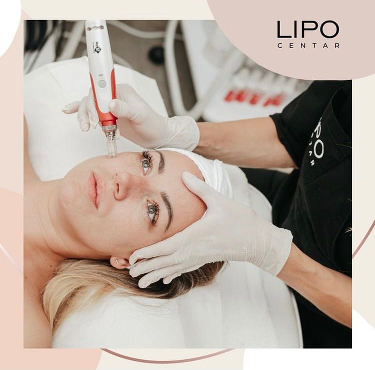 Dermapen - lice - Lipo Centar, Beograd Tretman lica Lice Tretman lica, Beograd, Zvezdara