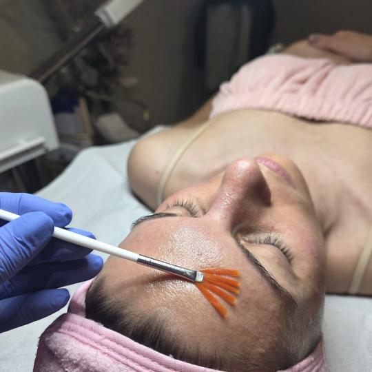 Starmedic #beograd Dermaroler i dermapen Holivudski sjaj - Jessner