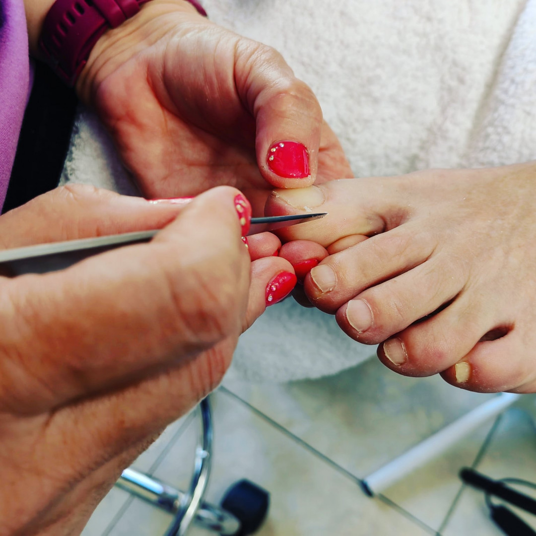 Vali&Nađa #novisad Medicinski pedikir Medicinski pedikir + urasli nokat