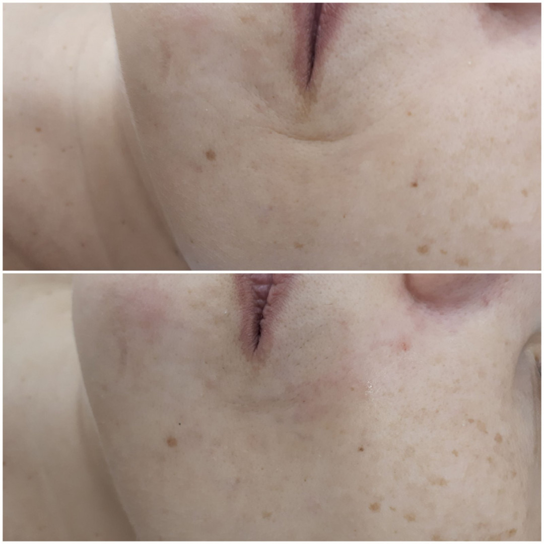 Essence of Beauty Academy #beograd Hijaluronski tretmani lica Hijaluron pen - 1 ml
