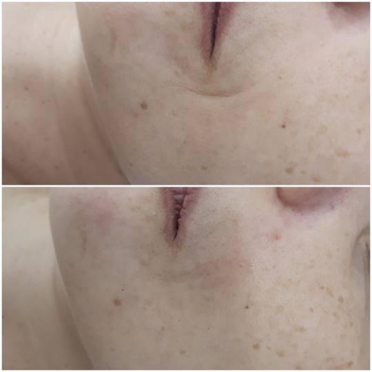 Essence of Beauty Academy #beograd Hijaluronski tretmani lica Hijaluron pen - 1 ml Popunjavanje nazo