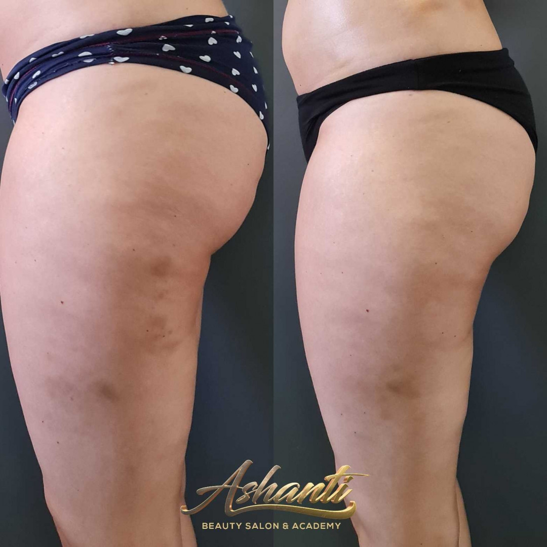 Ashanti Beauty Salon & Academy #beograd Masaža za mršavljenje Dermapen - regija lica