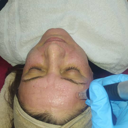 Akademija Stefanović #beograd Tretman lica Dermapen sa FUSION mezoterapijskim koktelima - tretman l