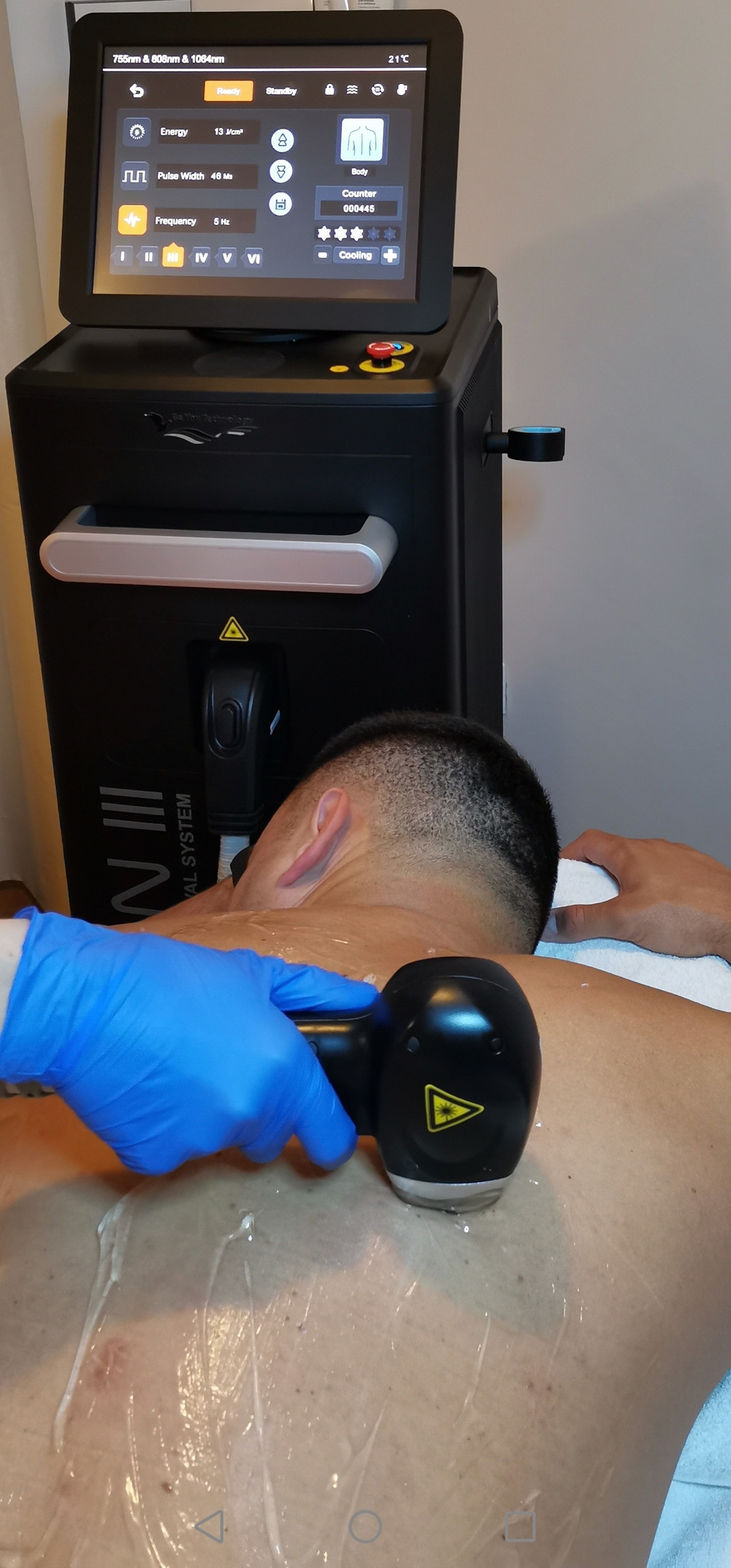 Glow beauty studio #beograd Laserska epilacija Laserska epilacija leđa - za muškarce