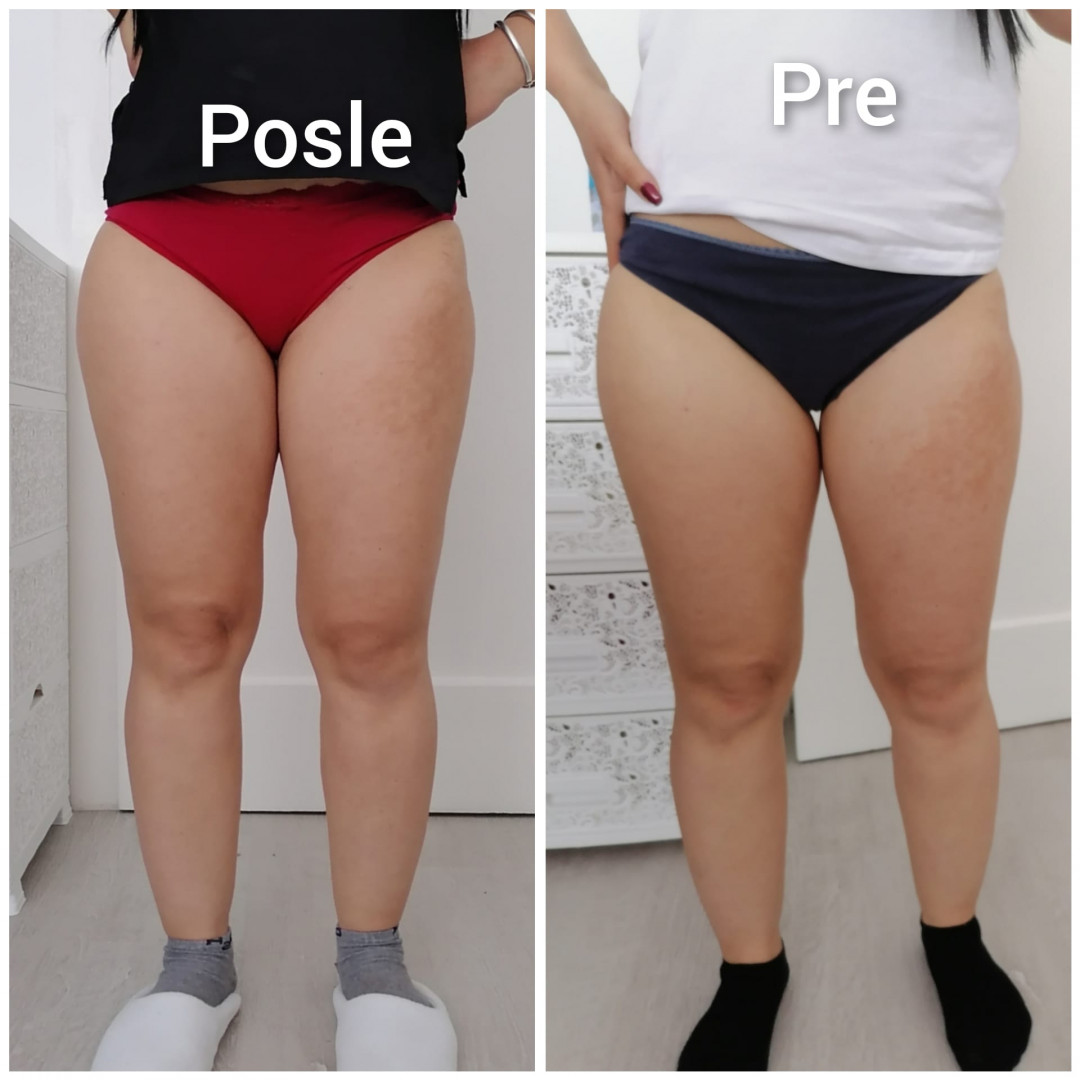 Skinlift Beauty Centar #nis Masaža za mršavljenje 4 tretmana kavitacije + 4 RF + 10 elektrostimulacije