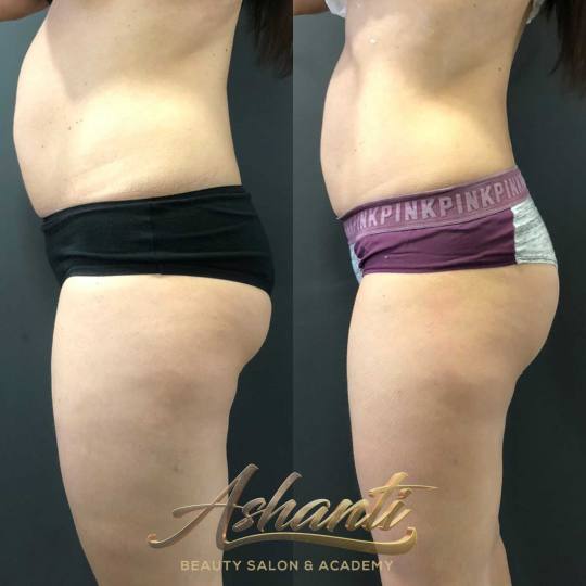 Ashanti Beauty Salon & Academy #beograd Kavitacija Pink ice body tretman - paket od 3 tretmana