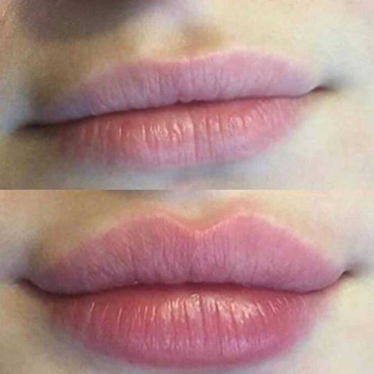Golden Duo massage & Wellness studio #beograd Tretman lica Jedne lepe usne,rađene Hijaluron Penom,m