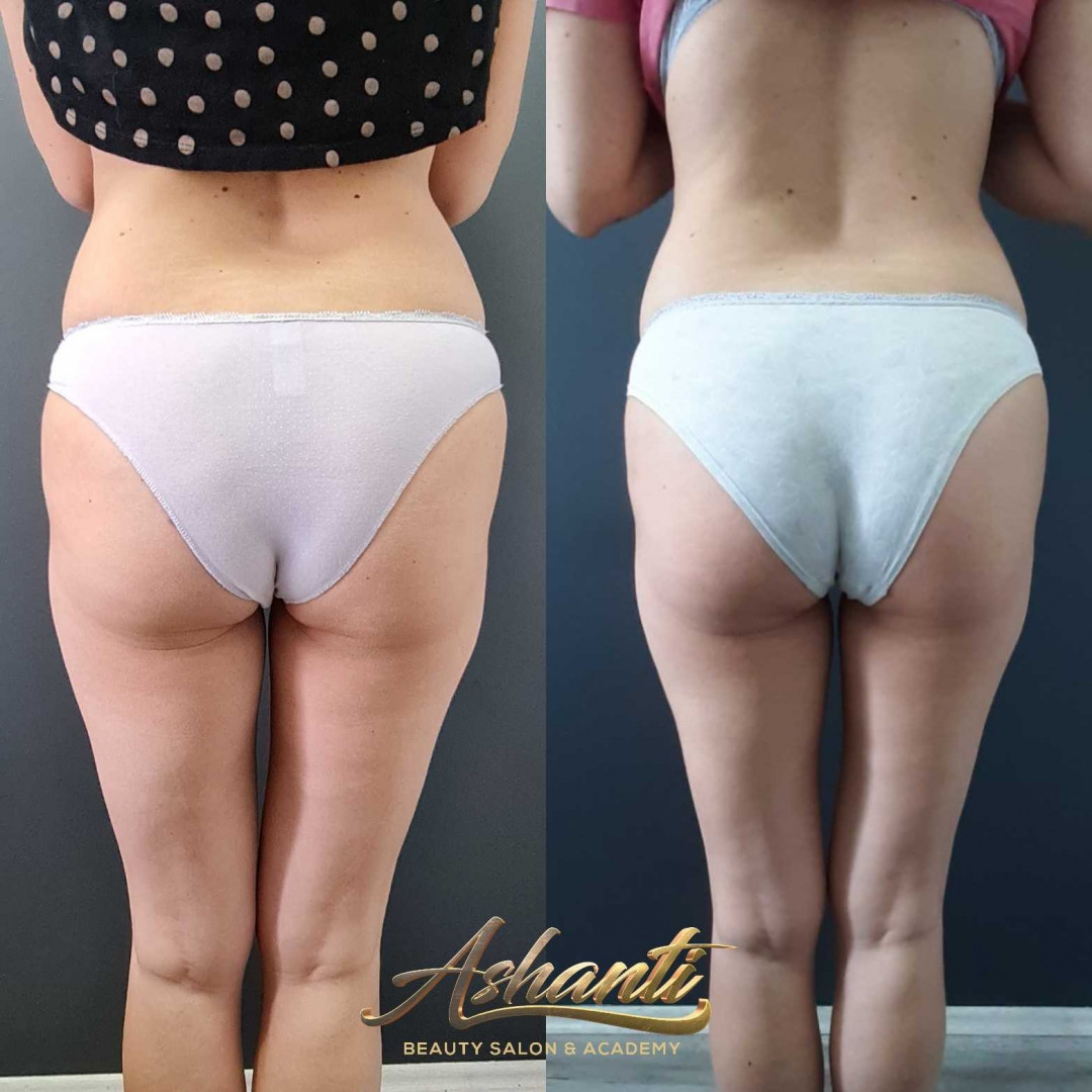 Ashanti Beauty Salon & Academy #beograd Masaža za mršavljenje Dermapen - regija lica