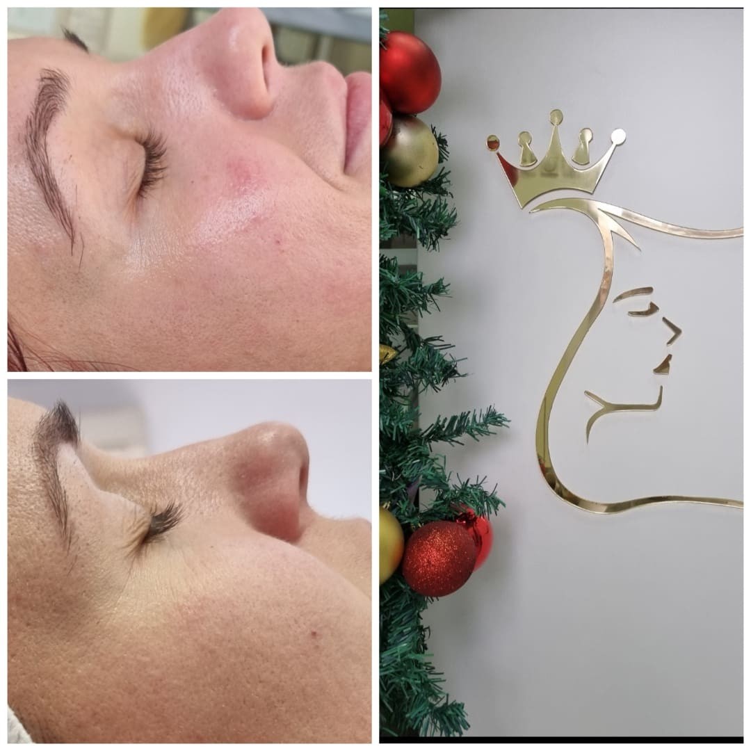 Emilly #beograd Tretman lica Biorevitalizacija lica