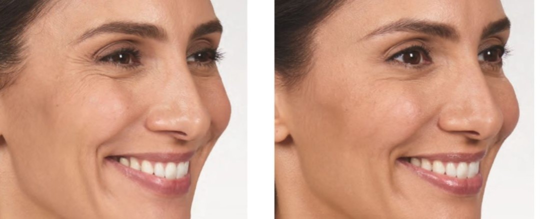 Dr Pantazis - Dental & Beauty Clinic #beograd Tretman lica Korekcija bora oko očiju