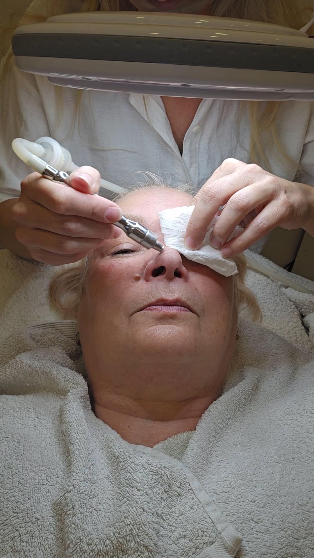 Laser lab by Ceca #novisad Mikrodermoabrazija Dijamantska mikrodermoabrazija + piling + komodoekspresija + maska