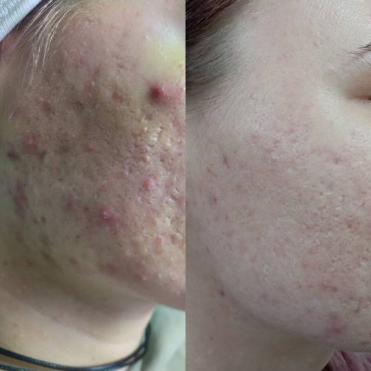 Factor Estetic #beograd Dermaroler i dermapen Acne stop tretman - paket od 4 tretmana