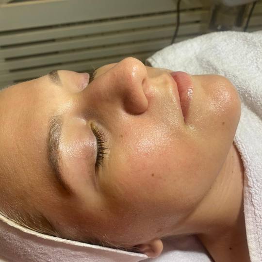 Angels #novisad Tretman lica Masaza lica sa lux maskom Vampire infusion
