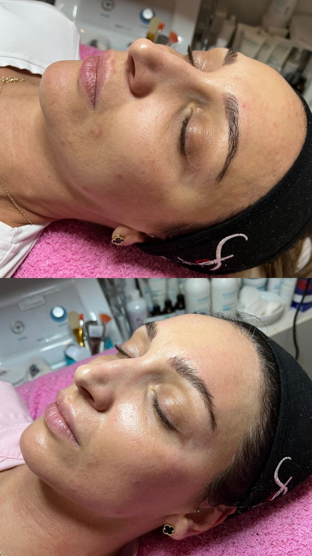 Mezoporacija lica - Choco Love, Beograd Tretman lica Lice Tretman lica, Beograd, Vračar, Čubura, Crveni krst