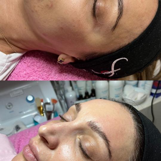 Choco Love #beograd Tretman lica Mezoporacija lica Tretman koji vraca hidrataciju i sjaj vec nakon p