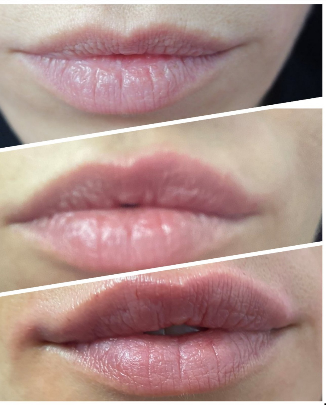 Blush Beauty Studio #beograd Hijaluronski tretmani lica Hijaluron Neauvia - 1 ml